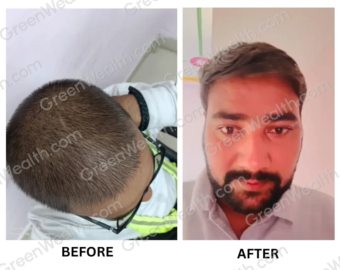 Before and after: thin, short hair on the crown seen from above, then thicker, fuller hair at the front (5)