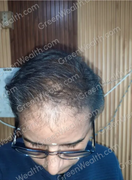 Before and after, seen from above: a man in glasses with thin hair and a bare crown, then a fuller, darker crown (1): After