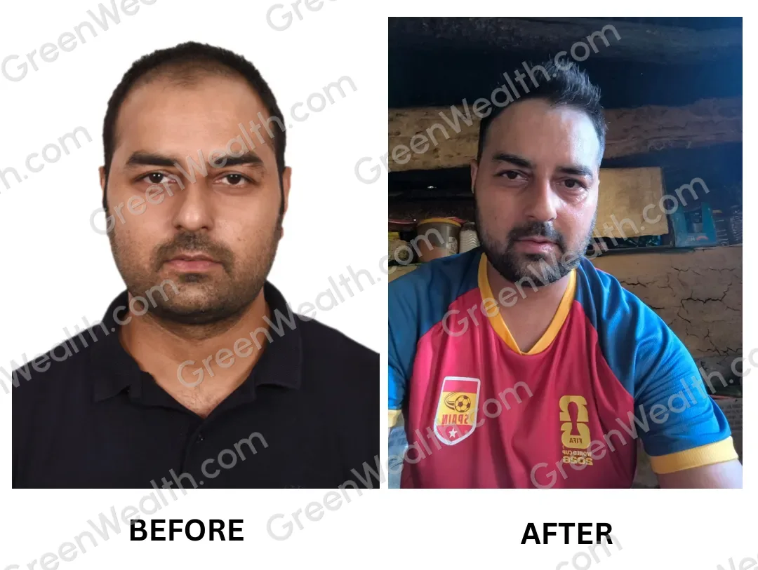 Before and after: a thinning, receding front hairline, then a fuller hairline (4)