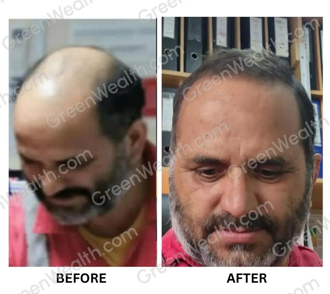 Before and after: a bald crown and receding hairline, then fuller grey and dark hair across the top (3)