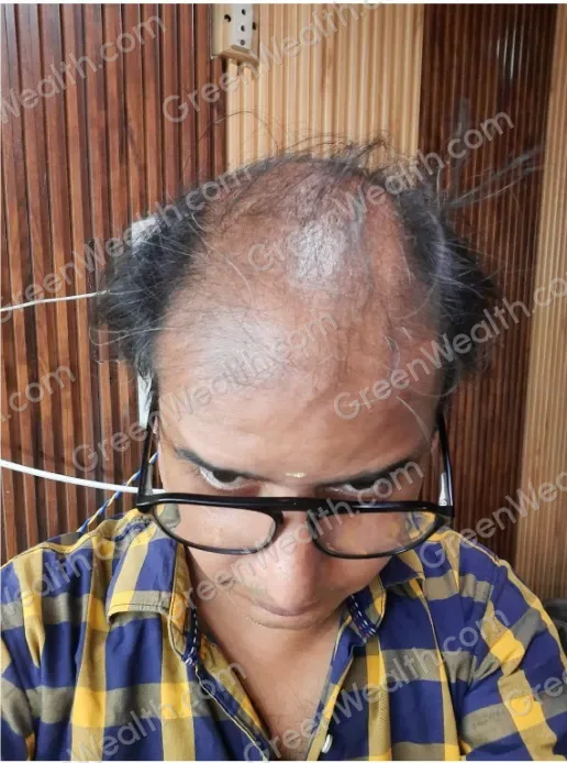 Before and after, seen from above: a man in glasses with thin hair and a bare crown, then a fuller, darker crown (1): Before