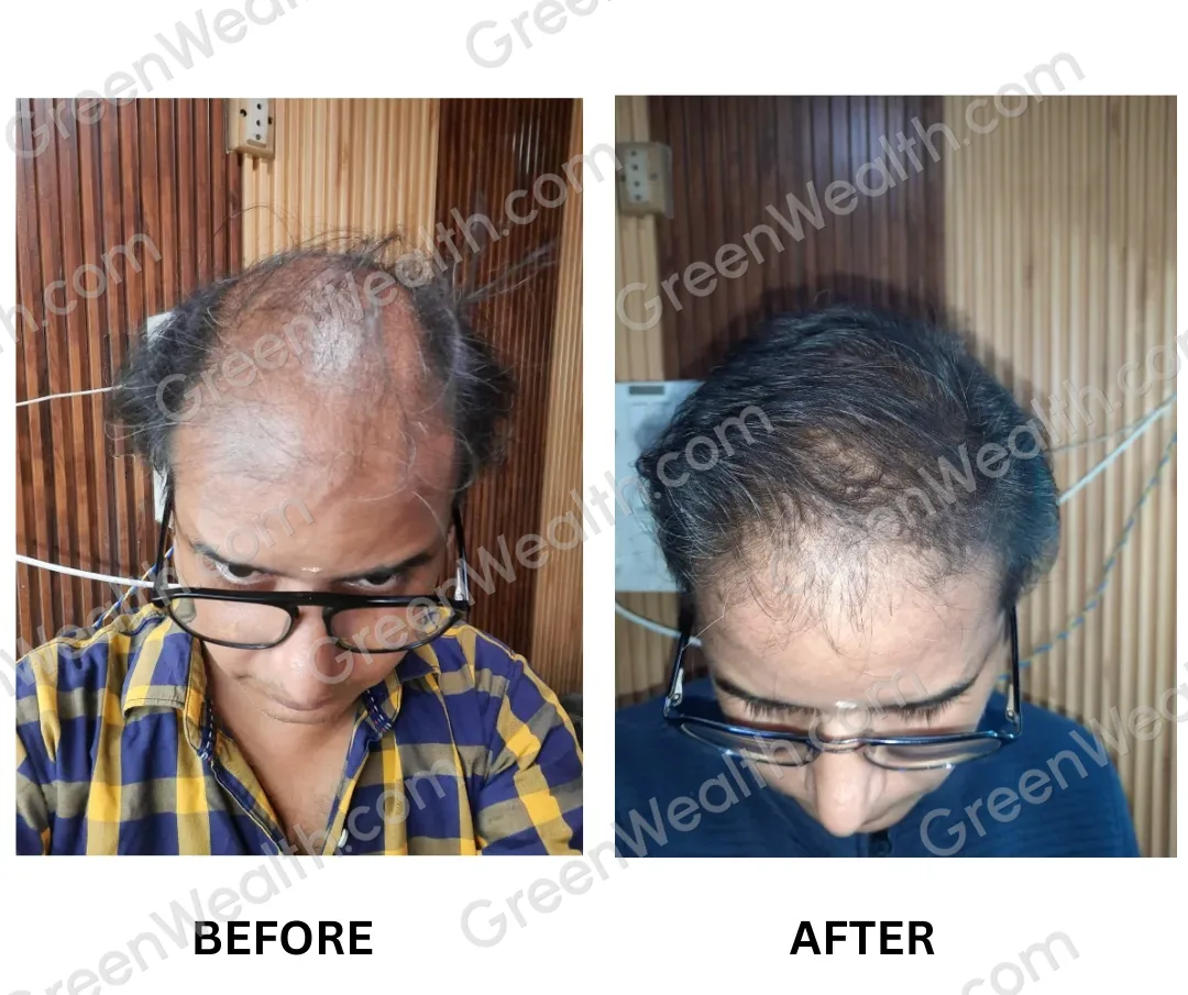 Before and after, seen from above: a man in glasses with thin hair and a bare crown, then a fuller, darker crown (1)