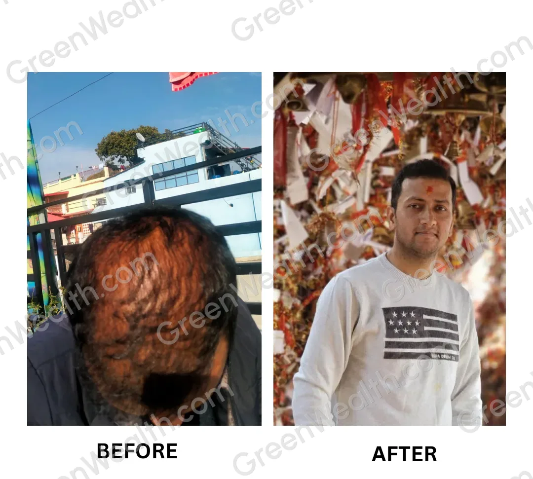 Before and after: thinning hair on top of the head seen from above, then a full head of hair (8)
