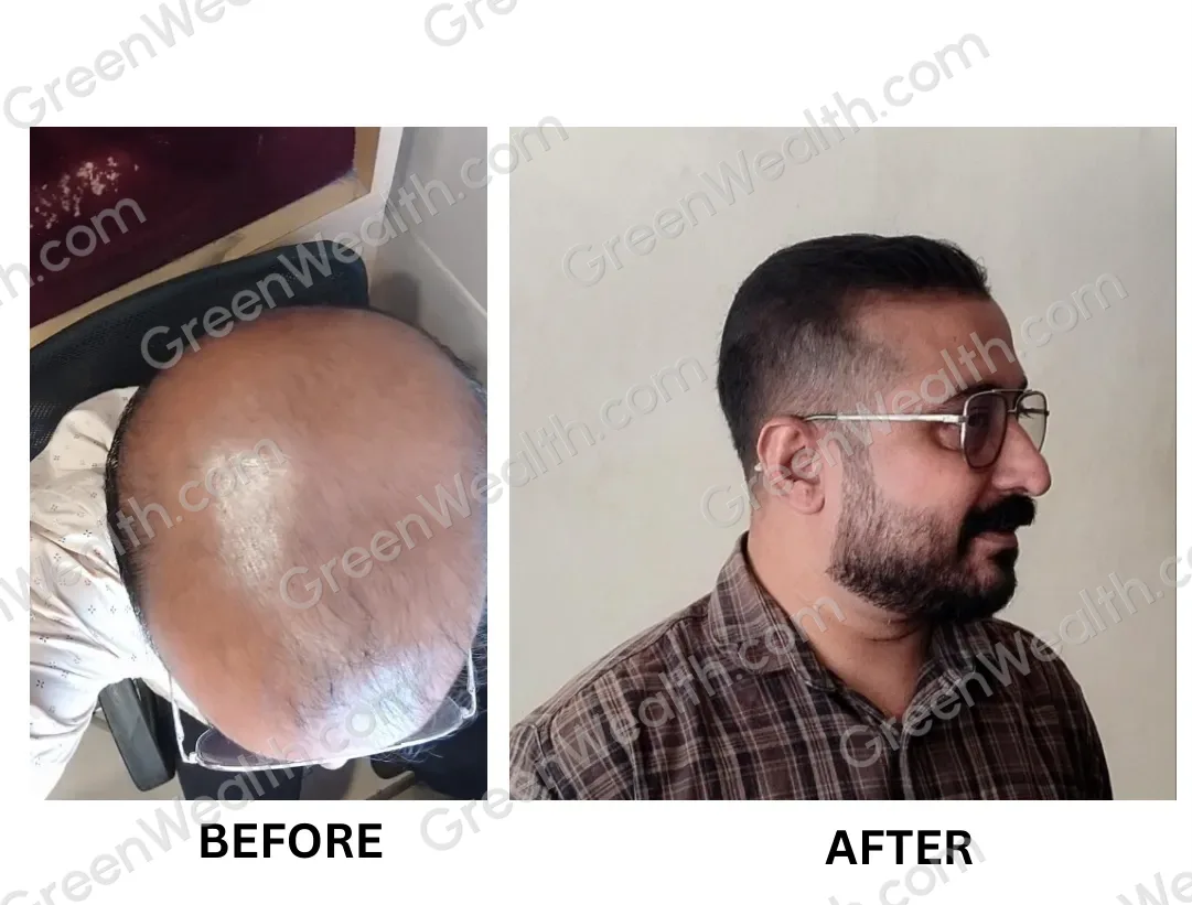 Before and after: a bald crown seen from above, then a full head of hair shown in profile (9)