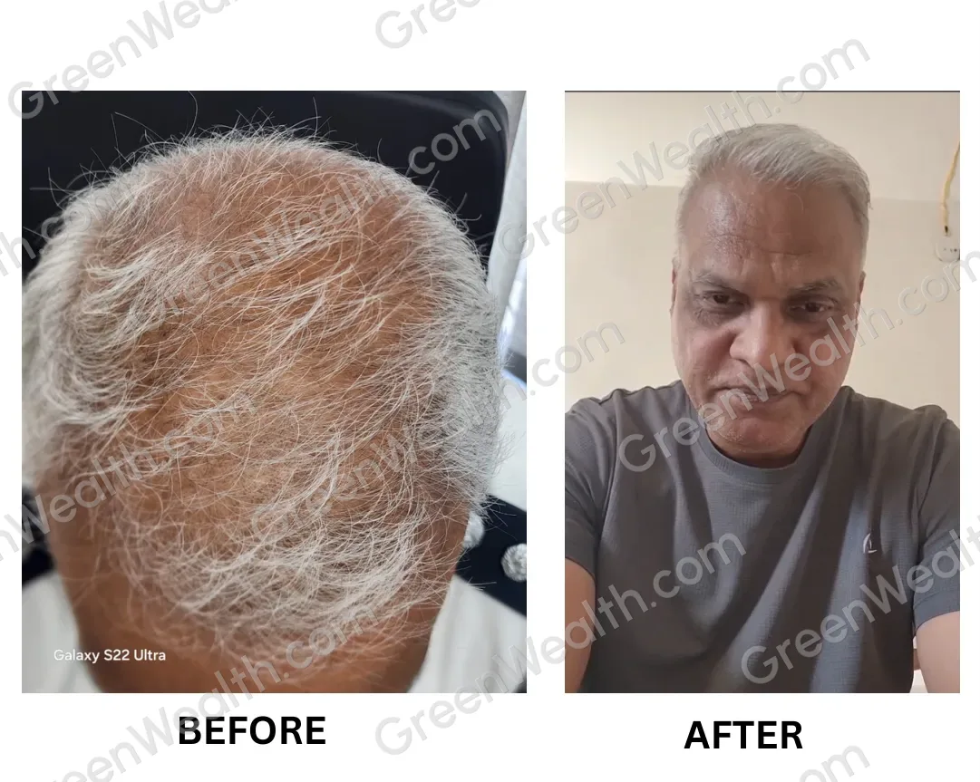 Before and after: thin grey hair with the scalp showing on the crown, then fuller grey hair (10)
