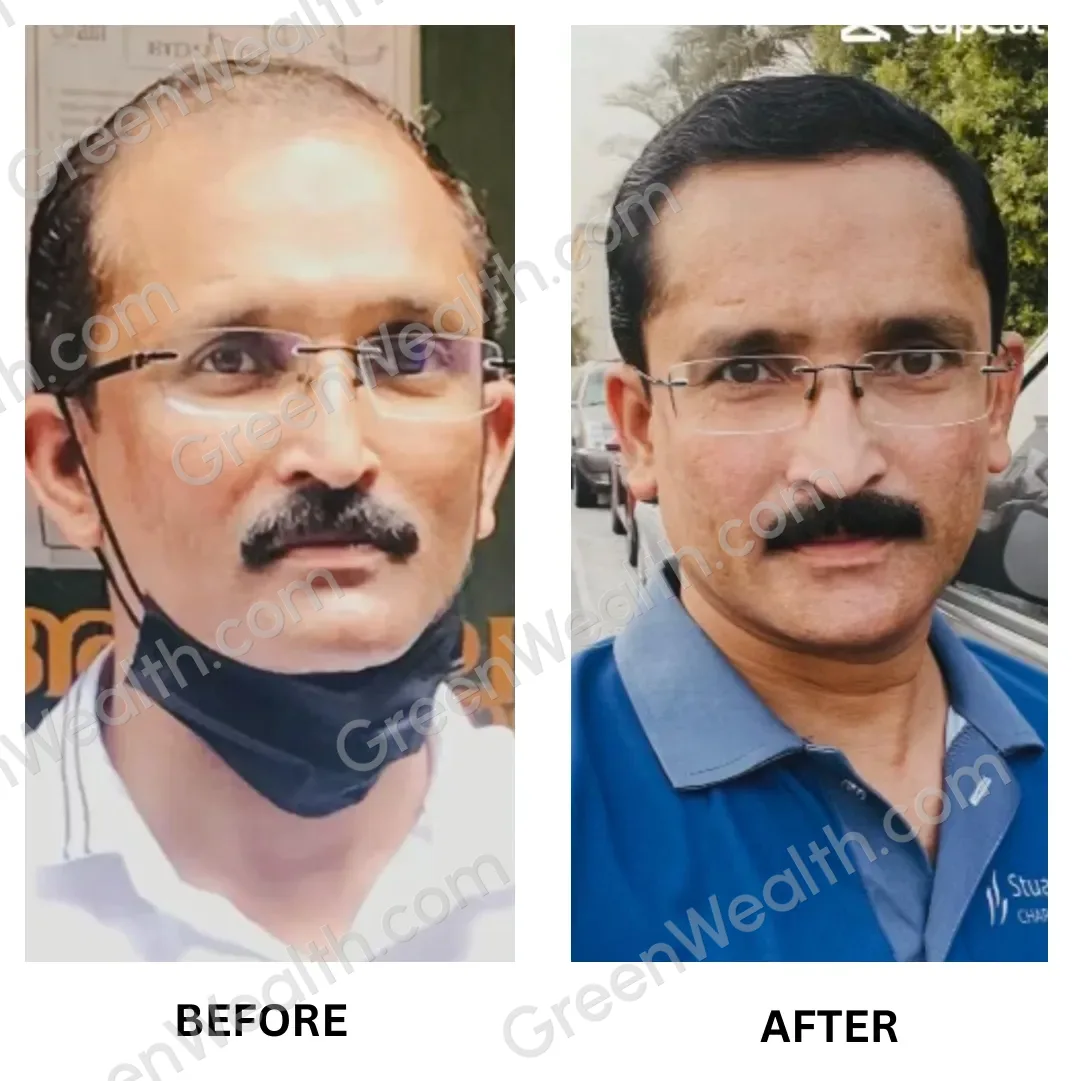 Before and after: a high, receding hairline on a man with glasses and a moustache, then a fuller, lower hairline (7)