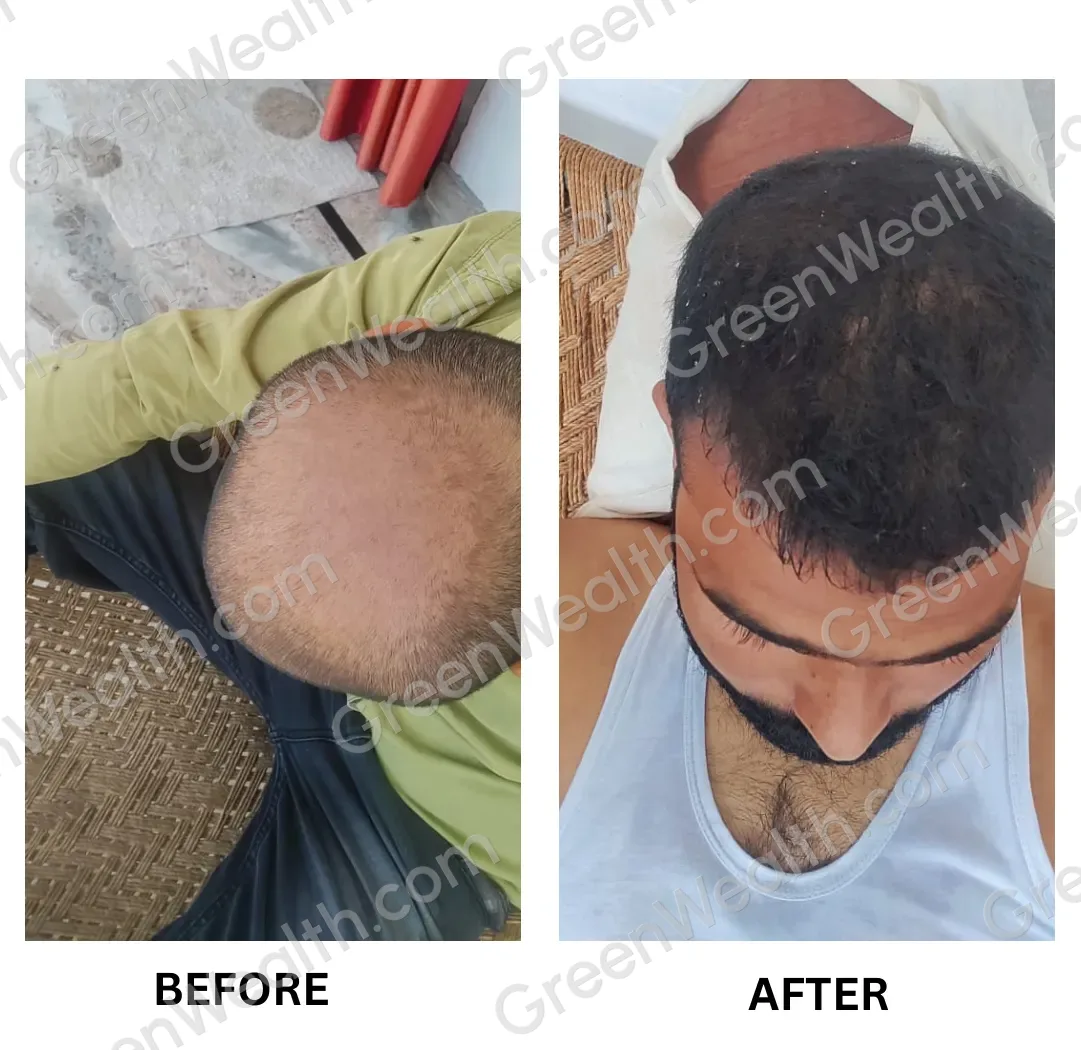 Before and after: a visibly thin crown seen from above, then dense, darker hair across the top (6)