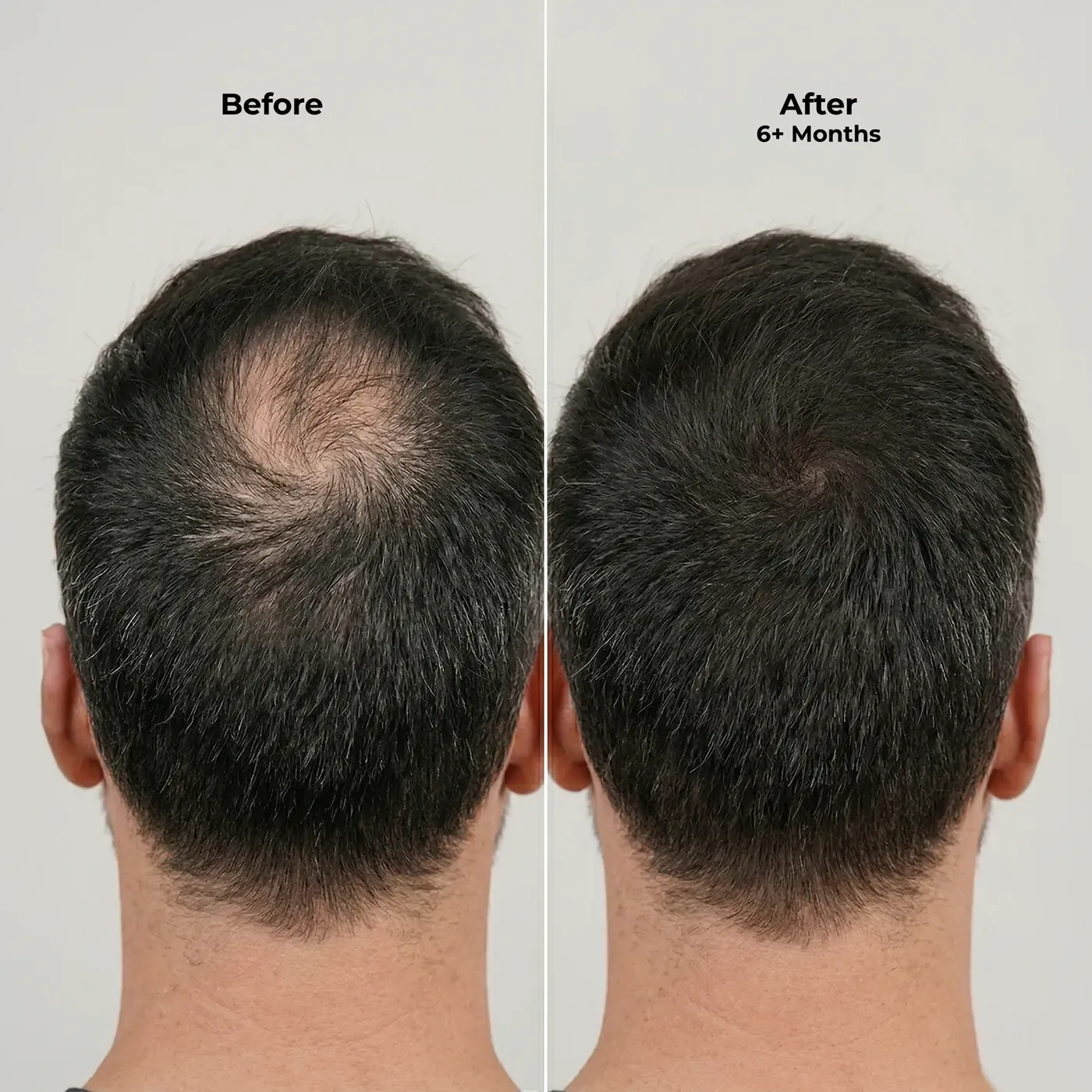 Ghori® Derma Roller presented with its packaging as a complete scalp kit
